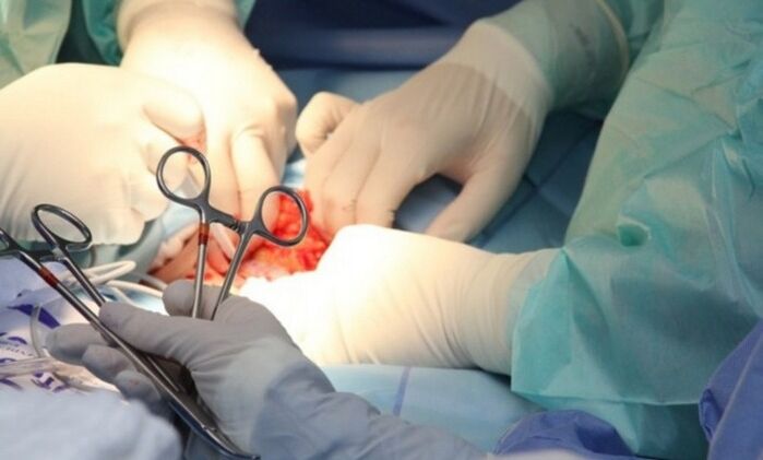 Chirurgie de ligamentotomie pour agrandir le pénis. 